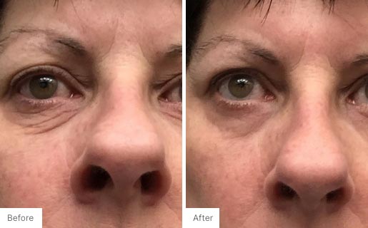 2 - Before and After Real Results photo of a woman's eye area.