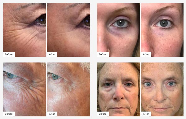 Before and After Real Results photography of customers using the Eye Serum and Eye Patch combo.
