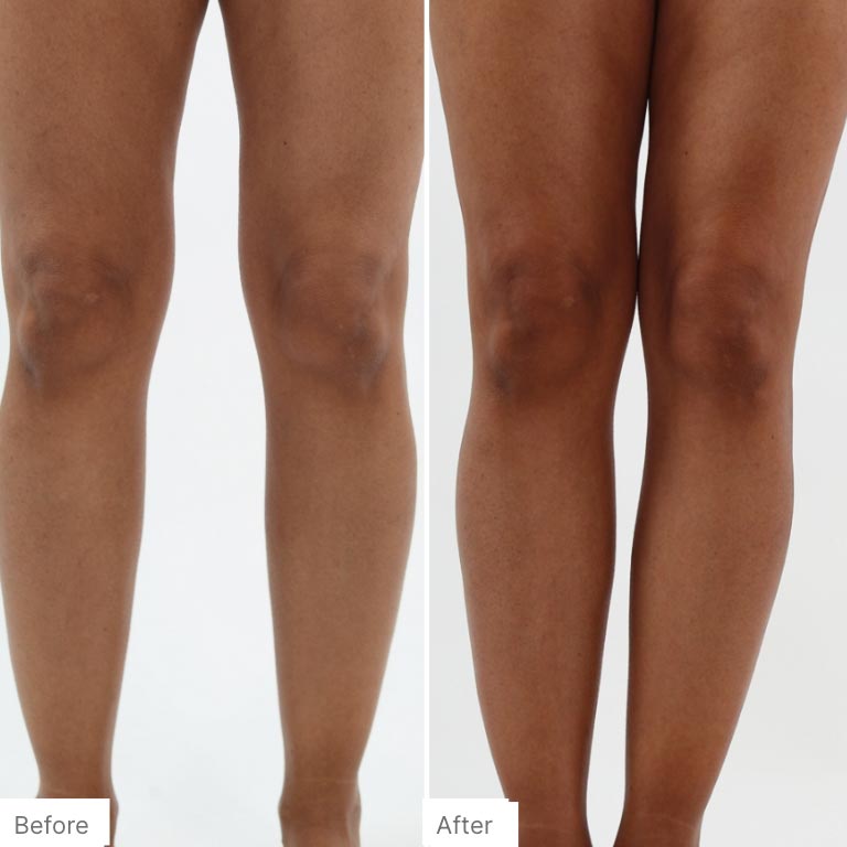 Before and after image of woman who has applied the self-tanner on her legs to enhance her natural skin tone. 